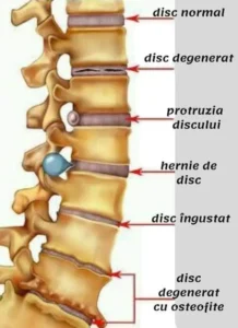 Ana_Horodinca_kinetoterapie_Focsani_hernie_de_disc_2