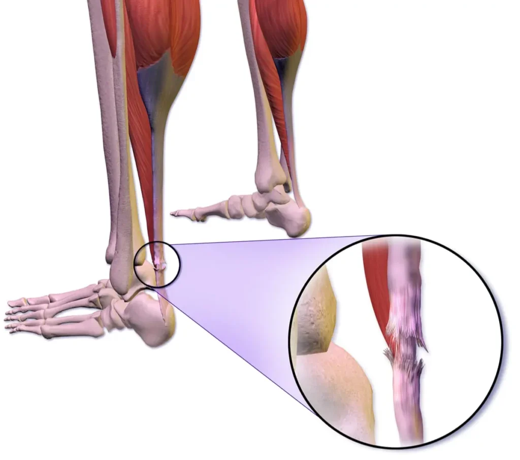Tendonul lui Ahile: Ce trebuie să știi despre afecțiuni, cauze și tratament 1 Tendonul lui Ahile - cabinet kineto Ana Horodinca - detalii
