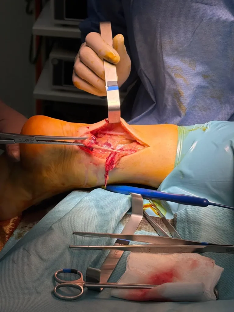 Tendonul lui Ahile: Ce trebuie să știi despre afecțiuni, cauze și tratament 3 Tendonul lui Ahile - cabinet kineto Ana Horodinca - operatie 2