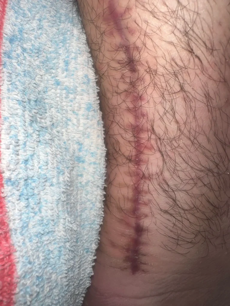 Tendonul lui Ahile: Ce trebuie să știi despre afecțiuni, cauze și tratament 4 Tendonul lui Ahile - cabinet kineto Ana Horodinca - operatie