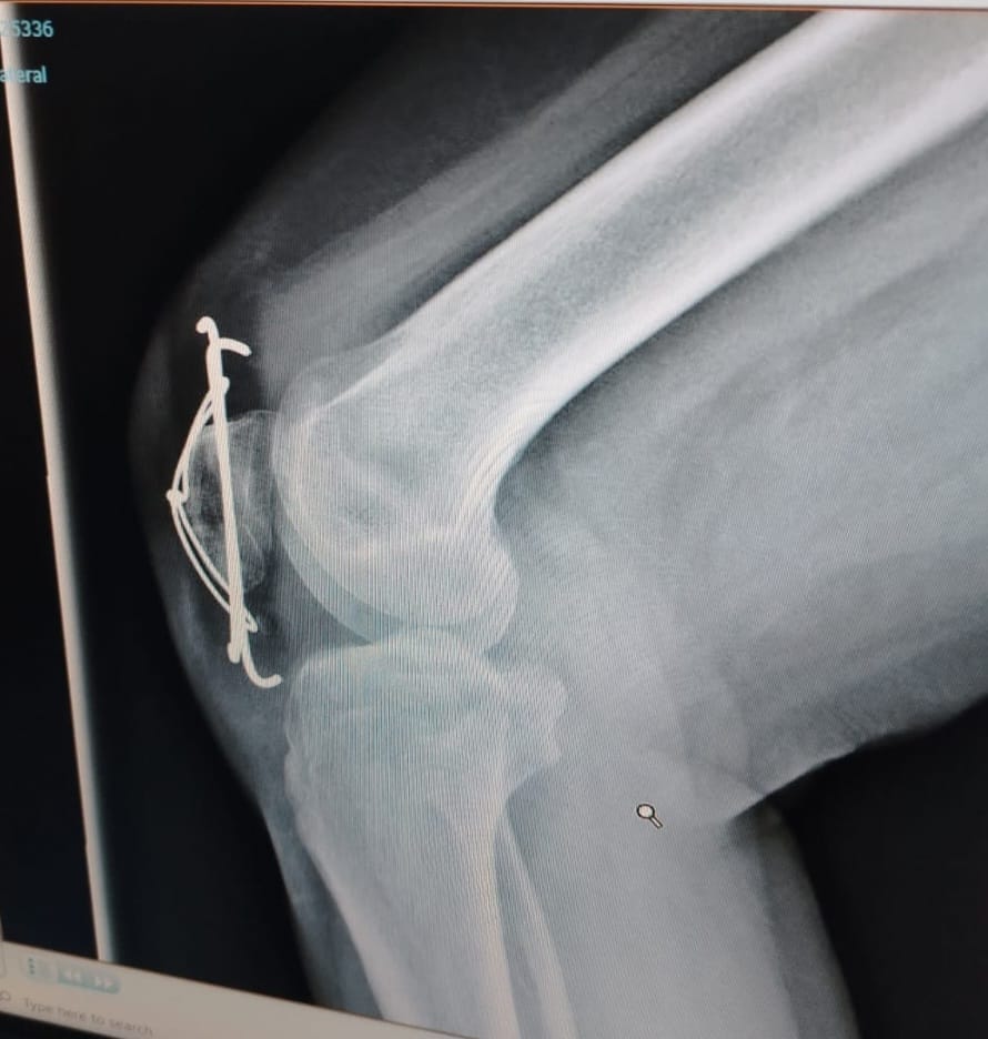Recuperare după fractură de rotulă la Focșani – povestea Codinei și succesul kinetoterapiei 1 Recuperare după fractură de rotulă