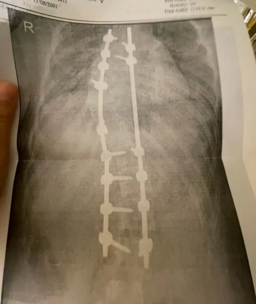Rezultat după operația de corecție a scoliozei cu fixare vertebrală
