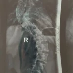 Radiografie scolioză toraco-lombară severă înainte de operație
