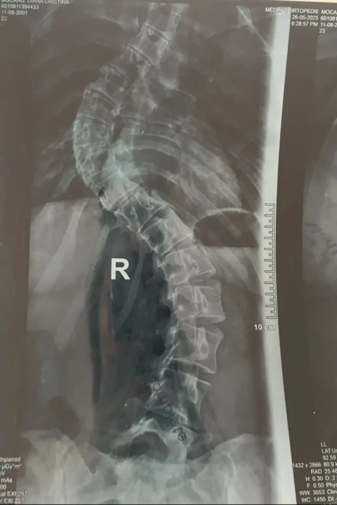 Radiografie scolioză toraco-lombară severă înainte de operație