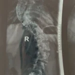 Radiografie scolioză toraco-lombară severă înainte de operație