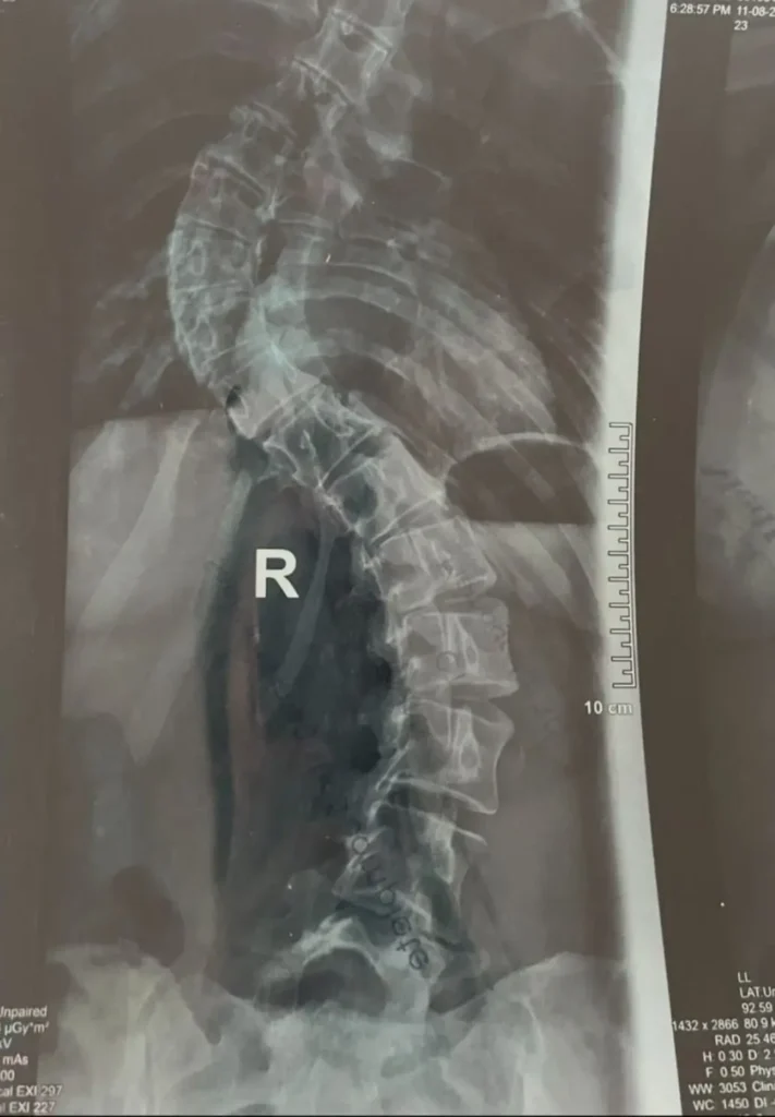 Recuperare după operația de scolioză toraco-lombară | Kinetoterapie Focșani – Povestea Dianei 2 Radiografie scolioză toraco-lombară severă înainte de operație
